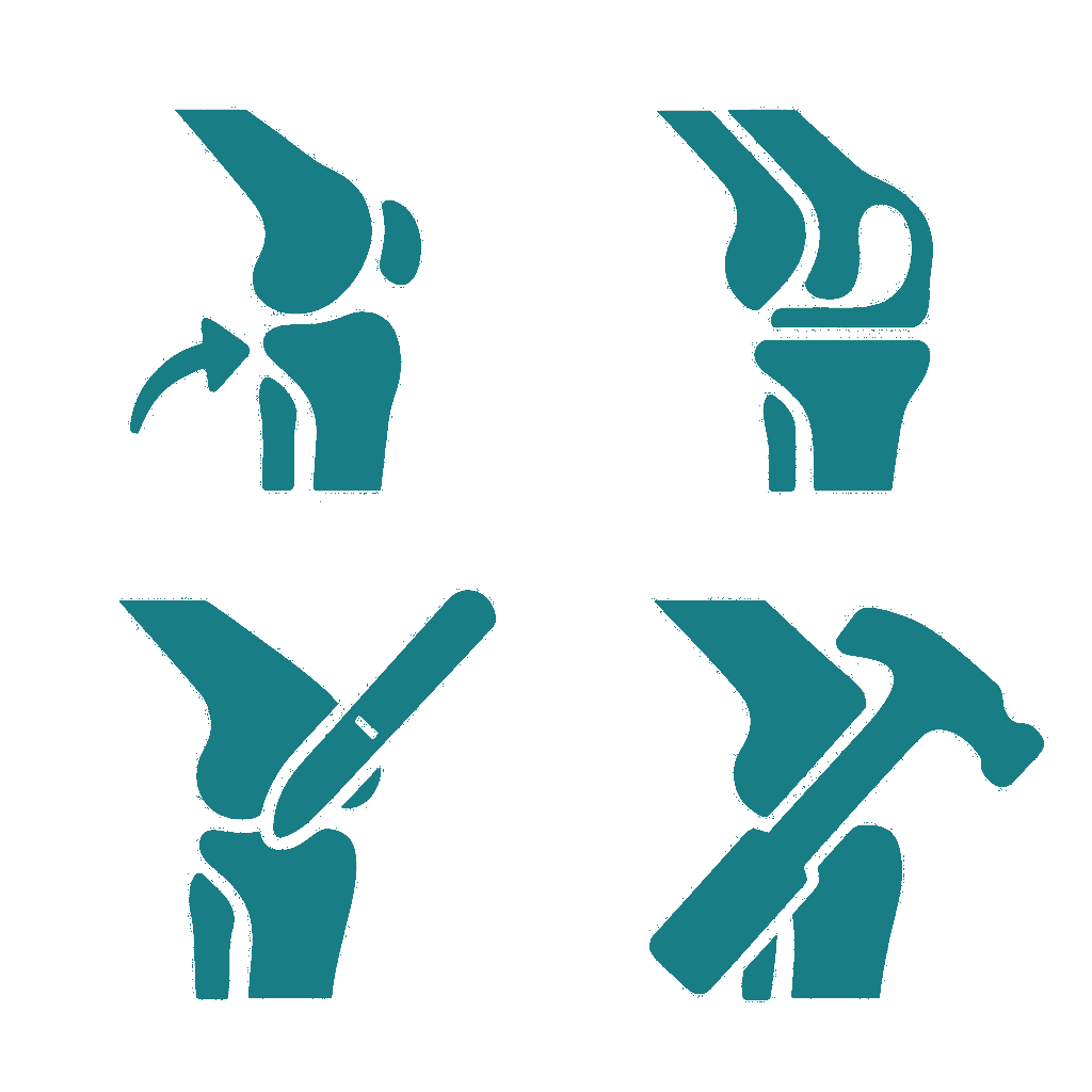 Joint Replacement Surgery